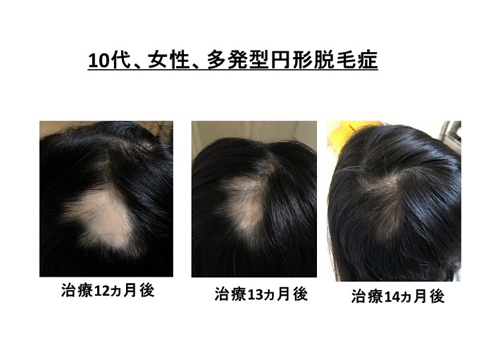 円形脱毛症　病院